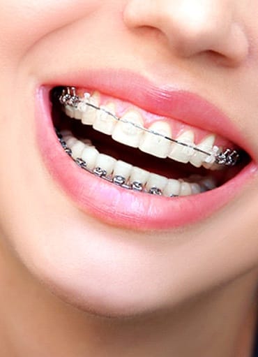 Closeup of woman smiling with braces