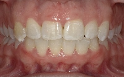 Closeup of flawless smile after cosmetic treatment